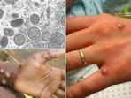 Virus-cacar-monyet-atau-monkeypox123.jpg
