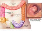 kanker-usus-besar-atau-colon-cancer.jpg