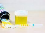 tes-urine-gagal-ginjal-akut.jpg