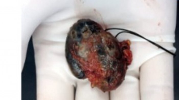 Dikira Kanker Ternyata Bukan, Penyakit Ini Tak Disangka Gara-gara Tato 15 Tahun Lalu