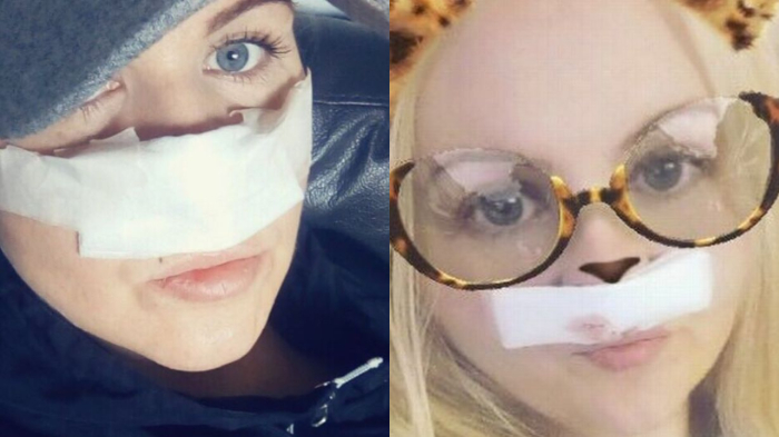 Hidungnya Jadi Begini setelah Operasi, Ibu Rumah Tangga Tak Berani Keluar Rumah Selama 2 Tahun