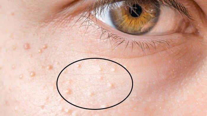 bintik-milia-di-sekitar-mata.jpg