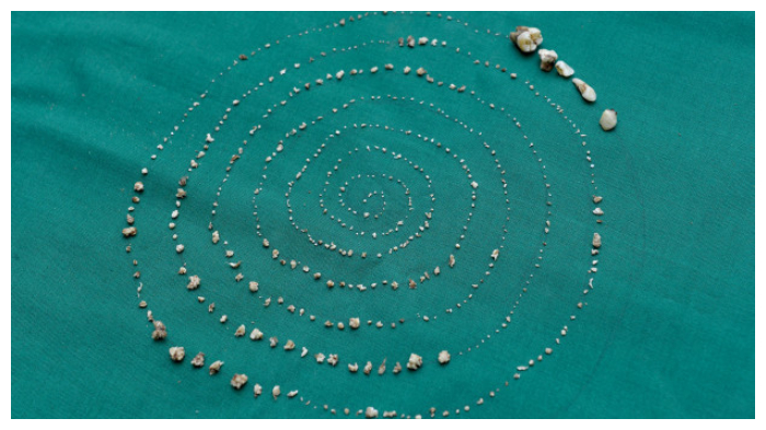 Video Anak 7 Tahun Miliki Gigi Sebanyak 526 Buah dengan Ukuran Bervariatif