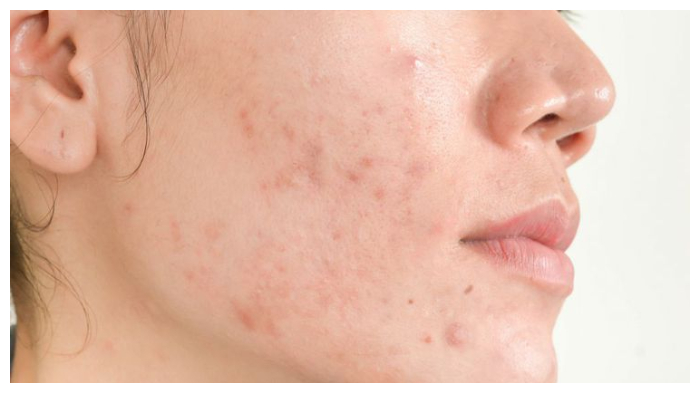 ilustrasi-jerawat-09457498.jpg