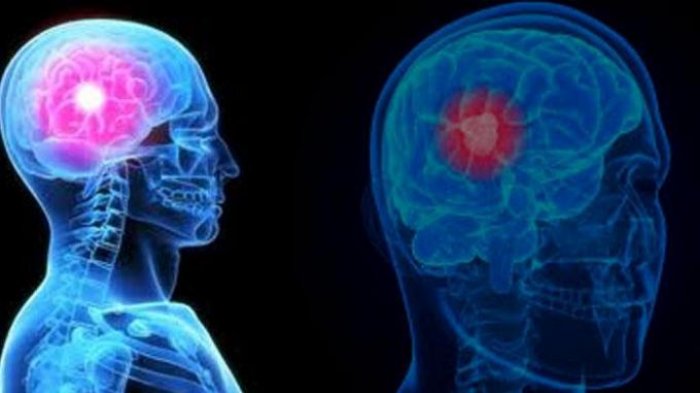 16 Gejala dan Ciri-ciri Kanker Otak Seperti Penyakit yang Merenggut Nyawa Dokter Ryan Thamrin