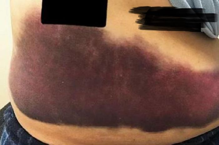 Astaga! Gara-gara Batuk, Seorang Nenek Patahkan Tulang Rusuknya, Ternyata. . .