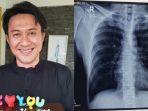 agus-kuncoro-dan-rontgen-rusuknya-pasca-kecelakaan-tunggal.jpg